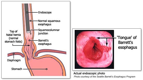 Perforatia esofagului